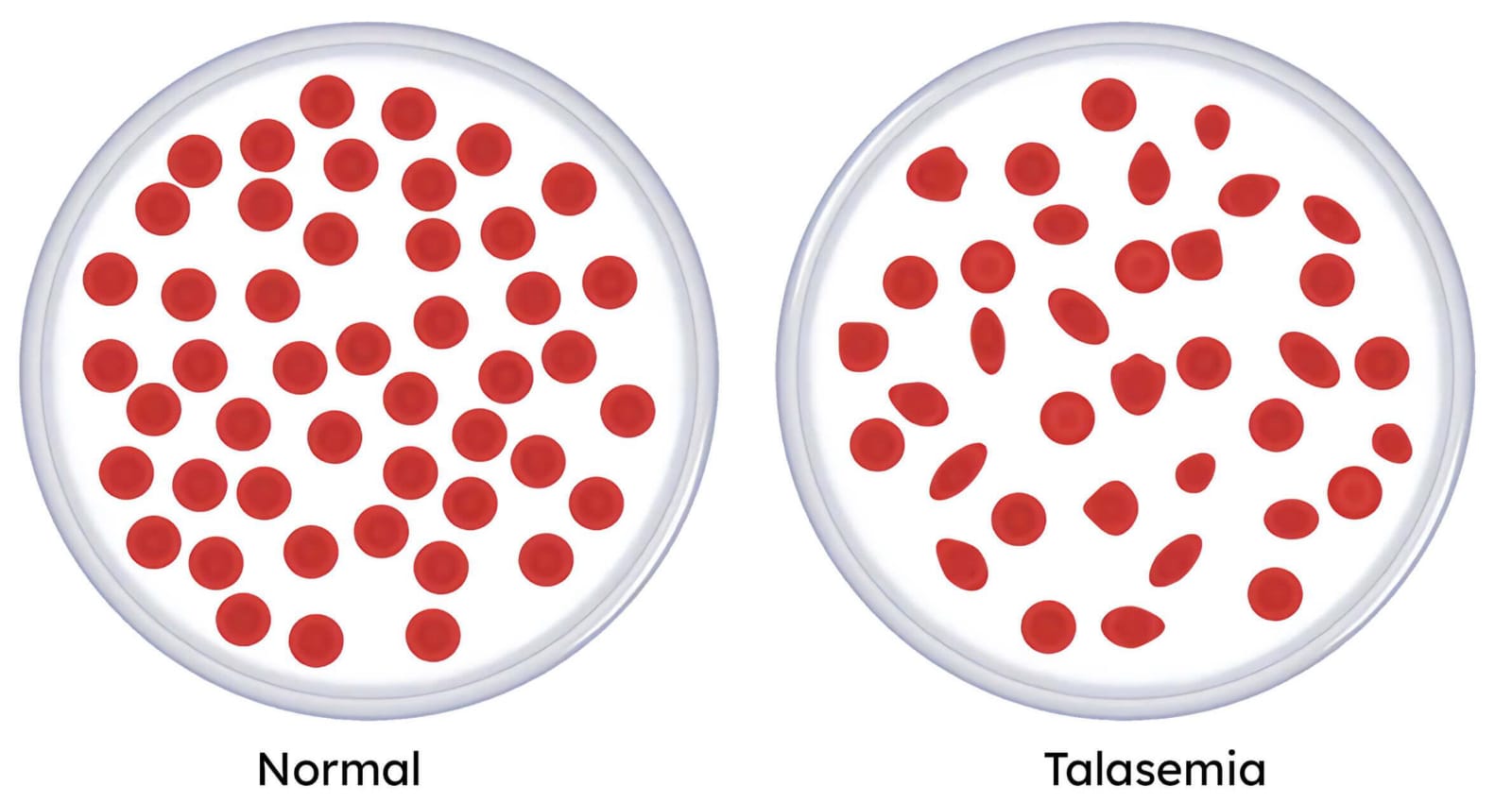Meningkatnya Kasus Talasemia di Indonesia: Waspadai Gejala dan Cara Pencegahannya