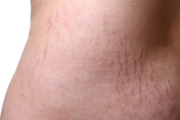 5 Cara Efektif Menghilangkan Stretch Mark: Solusi untuk Kulit Lebih Sehat
