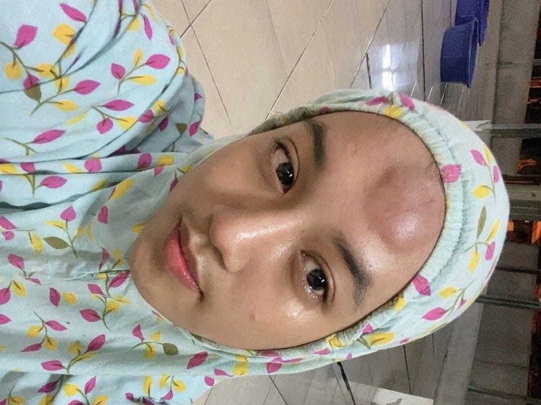 Viral, Kening Wanita Ini Benjol Akibat Terpeleset Saat Buat Konten