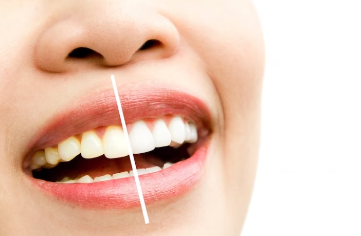 Tips Memutihkan Gigi Kuning Secara Alami Tanpa Perlu ke Dokter
