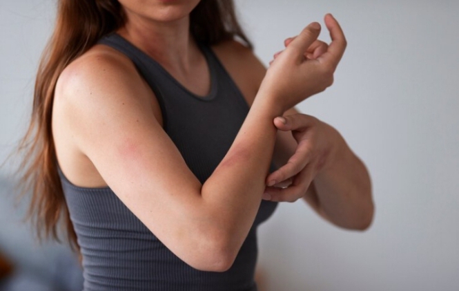 ‎Muncul Luka Lebam Tanpa Sebab, Bisa Jadi Masalah Serius