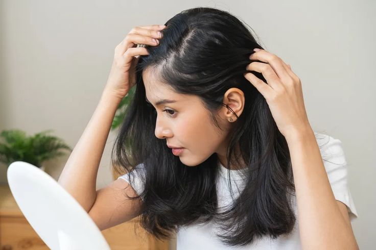 Ketombe Bisa Balik Lagi? Ini Alasan dan Cara Mengontrolnya agar Kulit Kepala Tetap Sehat