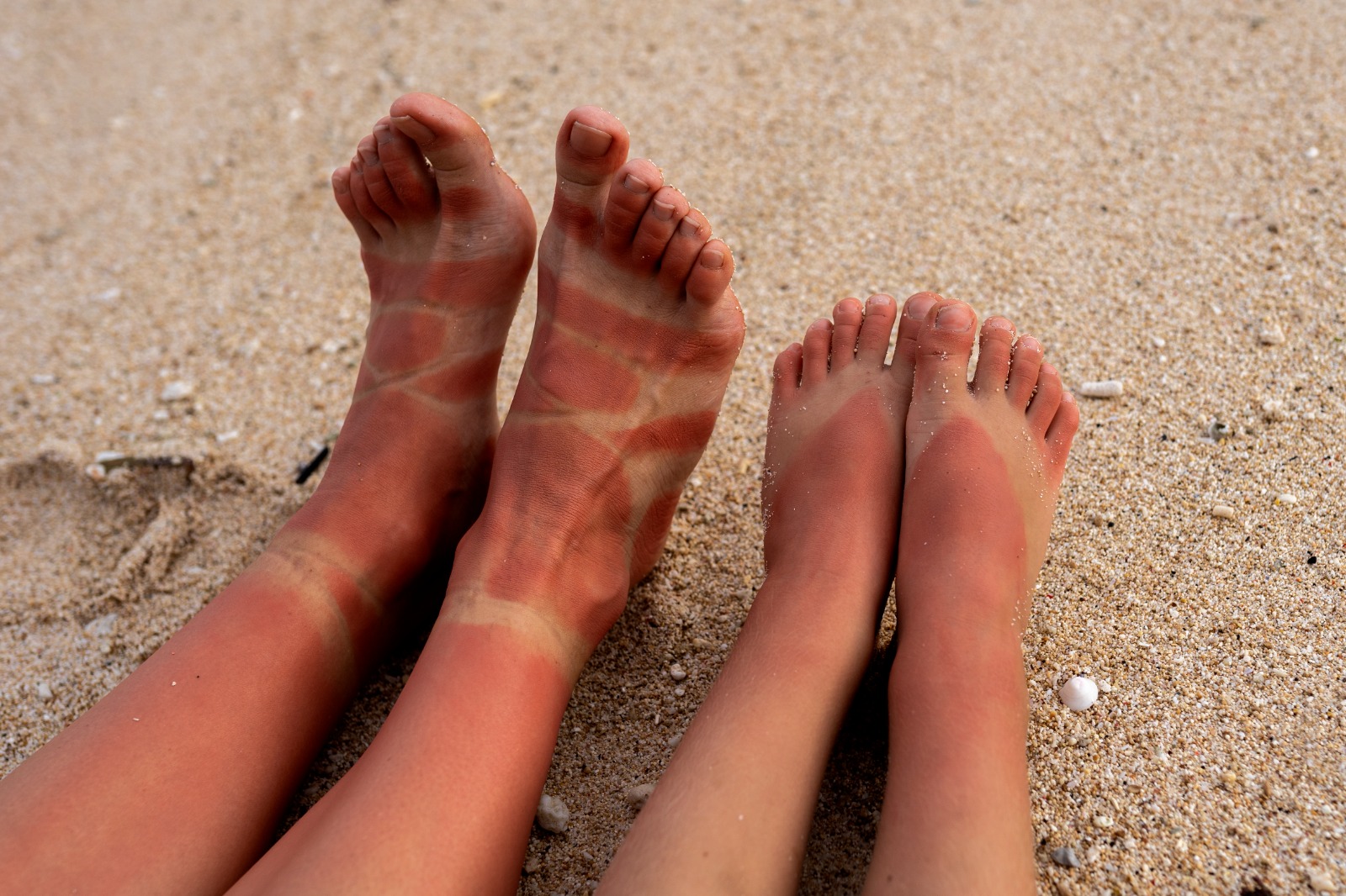 Tips Efektif untuk Mengatasi Kulit Belang di Kaki dan Membuatnya Terlihat Lebih Merata