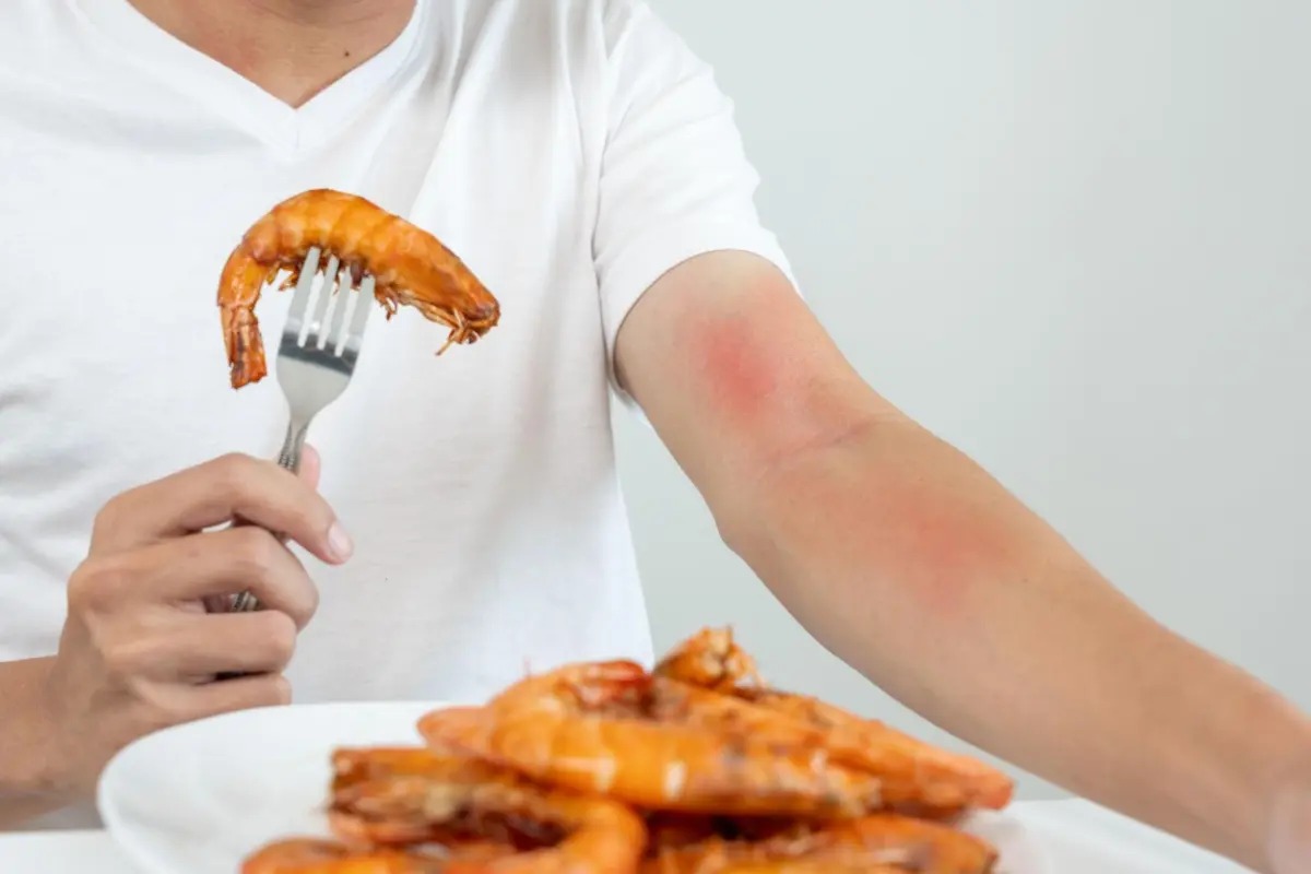 Jangan Keliru, Ini Beda Keracunan dan Alergi Makanan Menurut Dokter Anak