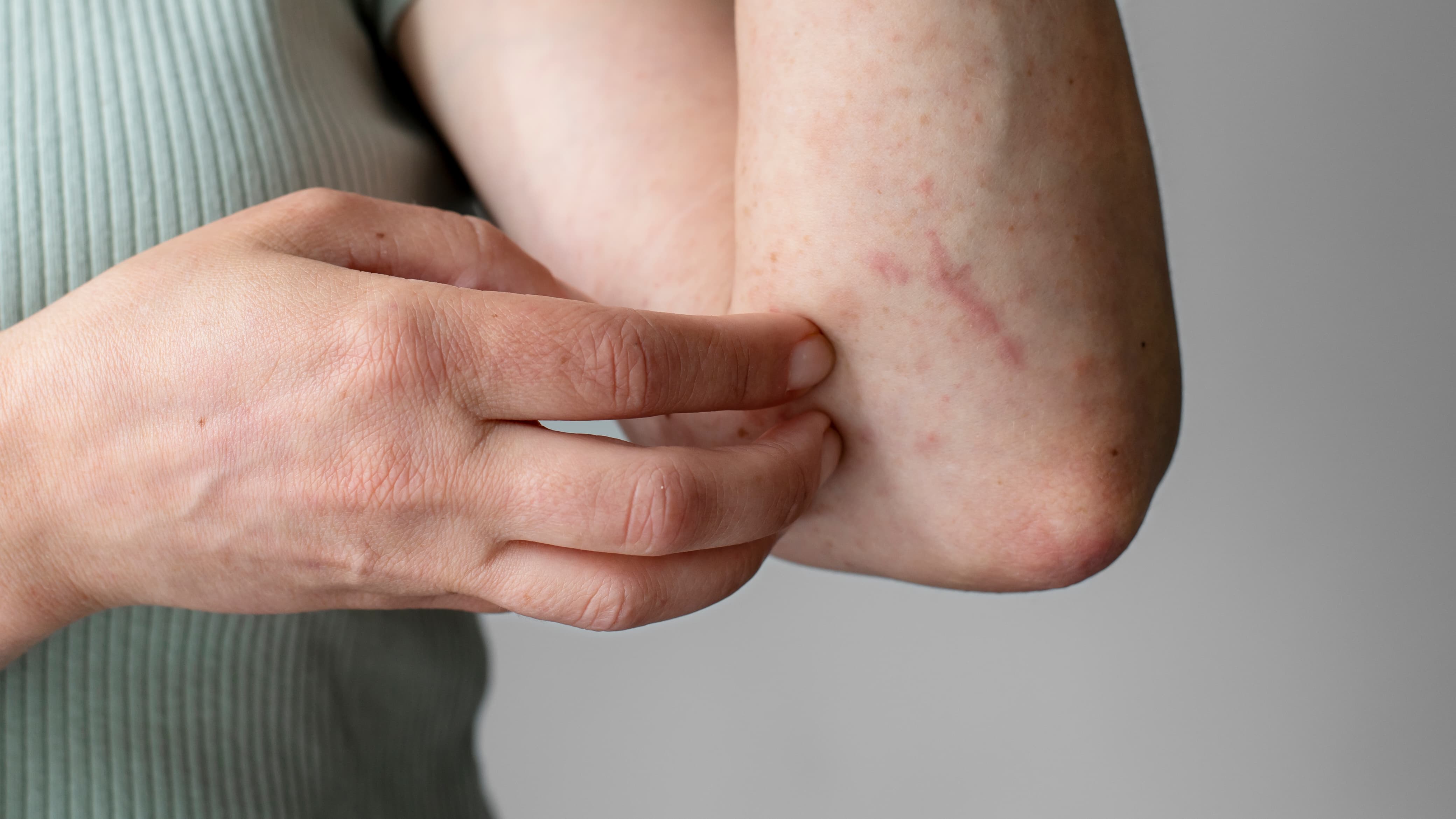 5 Bahan Alami di Dapur yang Ampuh Atasi Kulit Gatal