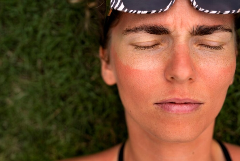 7 Risiko Paparan Sinar Matahari, Bisa Picu Kanker Kulit