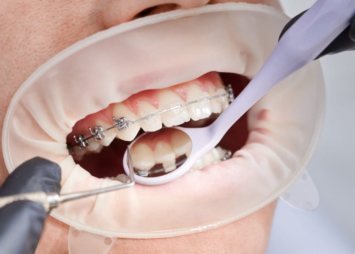 6 Tips Mengurangi Sakit Gigi Setelah Pasang Behel, Berikut Ini Tips yang Bisa Kamu Coba!