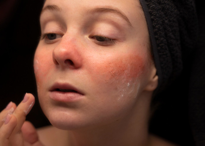 Tips Mengatasi Over Exfoliasi, Cukup Lakuin Ini