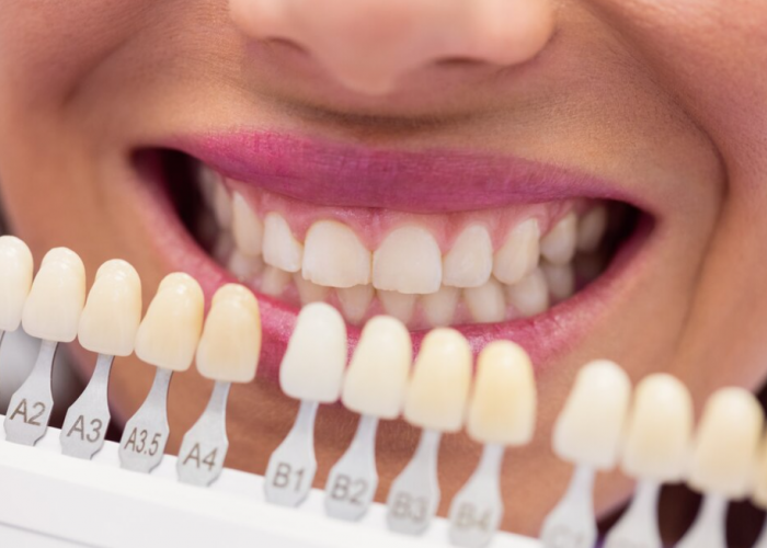 Pengertian, Prosedur dan Biaya Polishing Gigi yang Gak Mahal Tapi Bikin Warna Alami Gigi Lebih Sehat