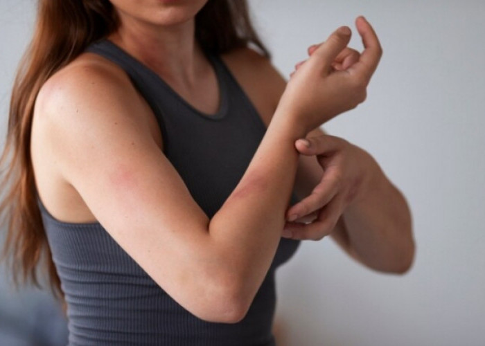 ‎Muncul Luka Lebam Tanpa Sebab, Bisa Jadi Masalah Serius