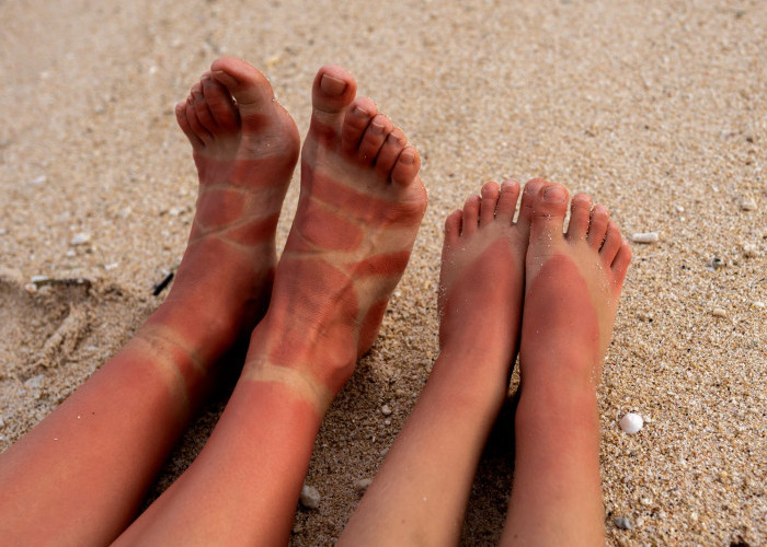 Tips Efektif untuk Mengatasi Kulit Belang di Kaki dan Membuatnya Terlihat Lebih Merata