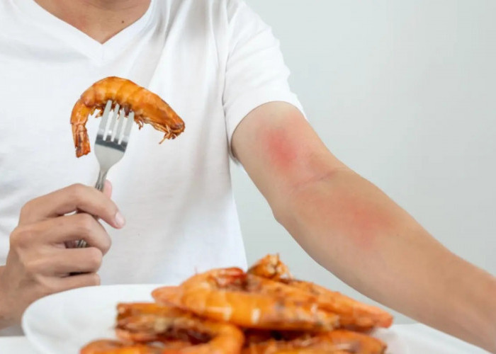Jangan Keliru, Ini Beda Keracunan dan Alergi Makanan Menurut Dokter Anak