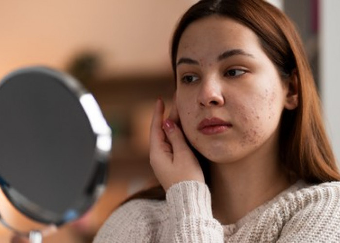 Mengenal Cortisol Face, Wajah yang Membengkak Akibat Stres