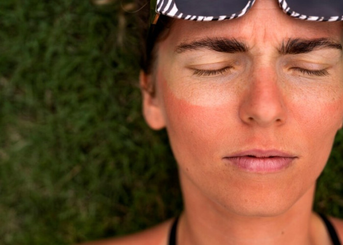 7 Risiko Paparan Sinar Matahari, Bisa Picu Kanker Kulit