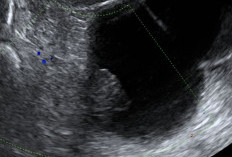 Ramai di TikTok, Banyak Perempuan Bagikan Pengalaman Kena Kista: Ini Gejala yang Perlu Diwaspadai