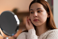 Mengenal Cortisol Face, Wajah yang Membengkak Akibat Stres