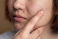 5 Kesalahan yang Harus Dihindari saat Wajah Berjerawat, Bikin Jerawat Cepat Hilang!